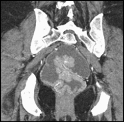 Rectal Cancer - CTisus CT Scan