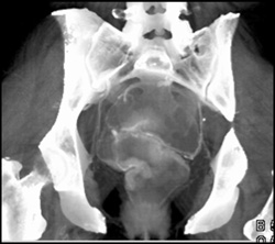 Rectal Cancer - CTisus CT Scan