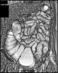 Normal Cecum - CTisus CT Scan