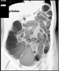 Normal Colon - CTisus CT Scan