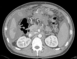 Carcinomatosis Due to Colon Cancer - CTisus CT Scan