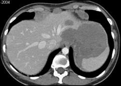 Pseudomyxoma Peritonei (PMP) - CTisus CT Scan