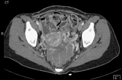 Pseudomyxoma Peritonei (PMP) - CTisus CT Scan