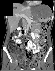 Pseudomyxoma Peritonei (PMP) - CTisus CT Scan