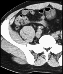 Appendicolith - CTisus CT Scan