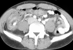 Appendiceal Abscess - CTisus CT Scan