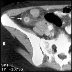 Appendicitis - CTisus CT Scan