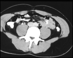 Appendicitis - CTisus CT Scan