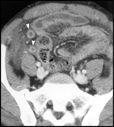 Appendicitis - CTisus CT Scan