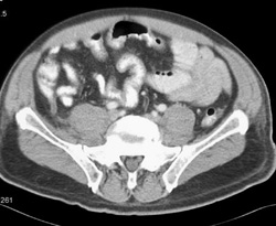 Appendicitis - CTisus CT Scan