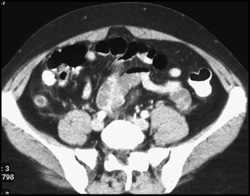 Appendicitis - CTisus CT Scan