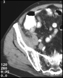 Appendicitis - CTisus CT Scan