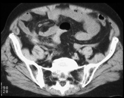 Appendicitis - CTisus CT Scan