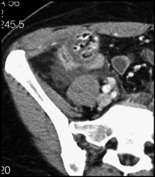 Appendicitis - CTisus CT Scan