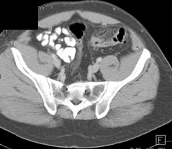 Diverticulitis - CTisus CT Scan