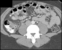 Appendicitis - CTisus CT Scan