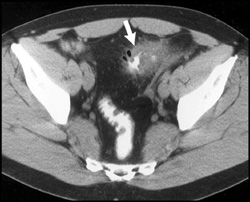 Diverticulitis - CTisus CT Scan