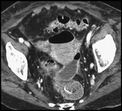 Pelvic Abscess - CTisus CT Scan