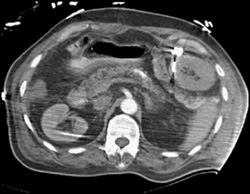 Retained Sponge in Left Upper Quadrant - CTisus CT Scan