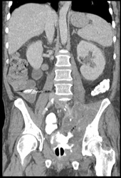 Perforated Colon With Abscess (was Colon Cancer) - CTisus CT Scan