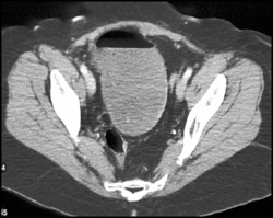 Sigmoid Volvulus - CTisus CT Scan