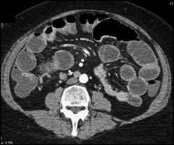 Cecal Cancer - CTisus CT Scan