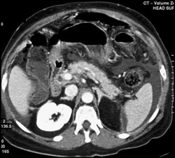 Carcinomatosis - CTisus CT Scan