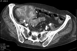 Cecal Cancer - CTisus CT Scan