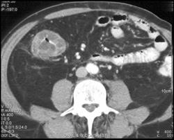 Right Sided Colon Cancer - CTisus CT Scan