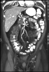 Pseudomembranous Colitis (PMC) - CTisus CT Scan