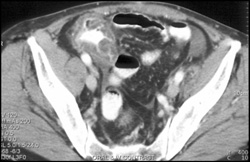 Pseudomembranous Colitis (PMC) - CTisus CT Scan