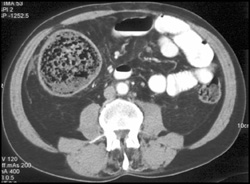 Dilated Cecum - CTisus CT Scan