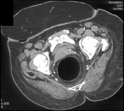 Sigmoid Colon Cancer - CTisus CT Scan