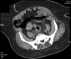 Colon Cancer - CTisus CT Scan