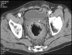 Rectal Cancer - CTisus CT Scan