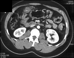 Perforated Colon - CTisus CT Scan