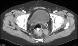 Implants on Rectum and Sigmoid Colon - CTisus CT Scan