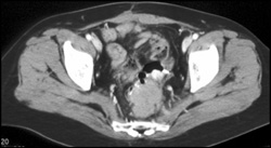 Implants on Rectum - CTisus CT Scan