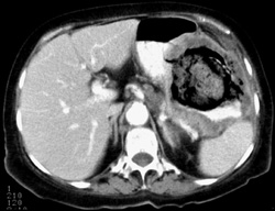 Colon Cancer Invades Stomach - CTisus CT Scan