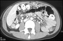 Carcinomatosis on Colon - CTisus CT Scan