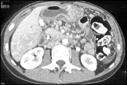 Carcinomatosis - CTisus CT Scan