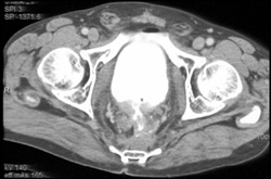 Rectal Cancer - CTisus CT Scan