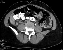 Appendicitis - CTisus CT Scan