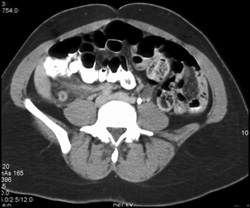 Appendicitis - CTisus CT Scan