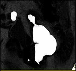 Sigmoid Carcinoma - CTisus CT Scan