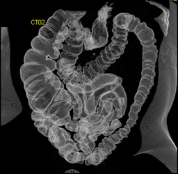 Nice Reflux of Air Into the Small Bowel - CTisus CT Scan