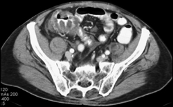 Pseudomembranous Colitis (PMC) - CTisus CT Scan