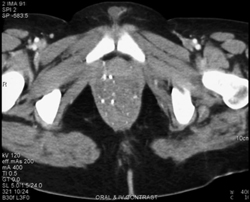 Rectal Calcifications in Klippel-Trenaunay-Weber Syndrome - CTisus CT Scan