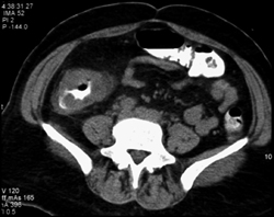 Ischemic Colitis - CTisus CT Scan