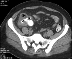 Ischemic Colitis - CTisus CT Scan